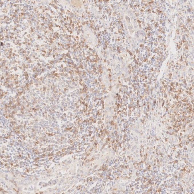 Immunohistochemistry (IHC) staining of human lymphoma tissue using Anti-Human CD45RO (UCHL1) (65150-1-Ig)