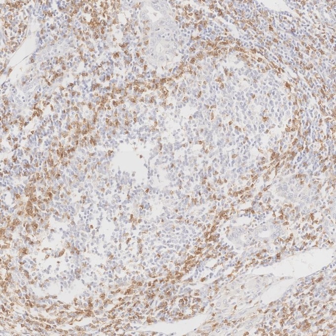 Immunohistochemistry (IHC) staining of human lymphoma tissue using Anti-Human CD45RO (UCHL1) (65150-1-Ig)