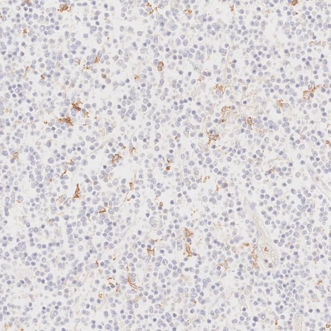 Immunohistochemistry (IHC) staining of human lymphoma tissue using Anti-Human CD45RO (UCHL1) (65150-1-Ig)
