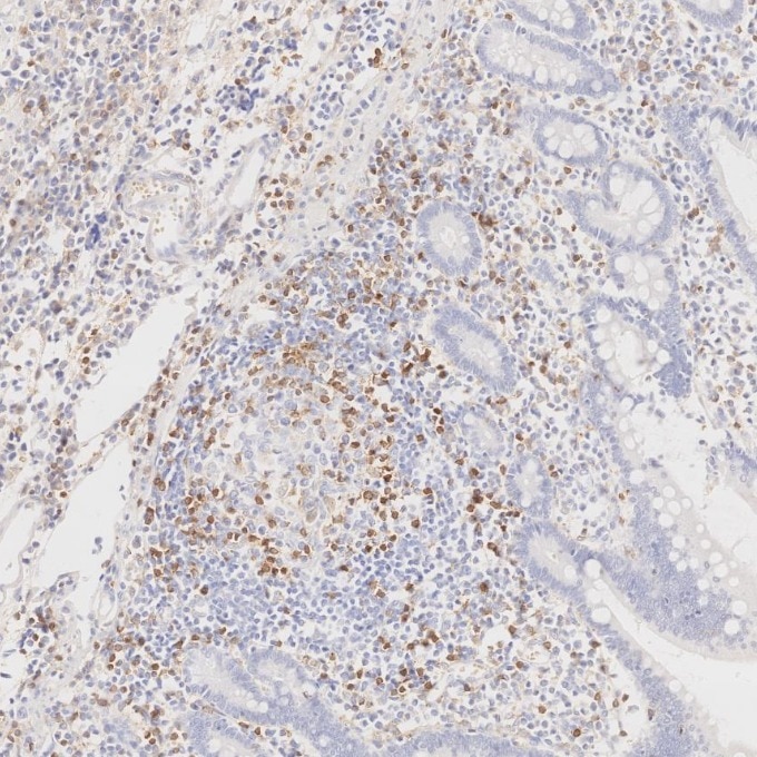 Immunohistochemistry (IHC) staining of human lymphoma tissue using Anti-Human CD45RO (UCHL1) (65150-1-Ig)