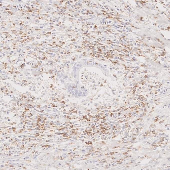 Immunohistochemistry (IHC) staining of human colorectal cancer tissue using Anti-Human CD45RO (UCHL1) (65150-1-Ig)