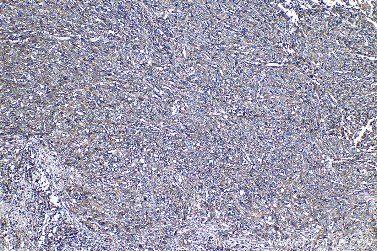 Immunohistochemistry (IHC) staining of human cervical cancer tissue using CD46 Polyclonal antibody (12494-1-AP)