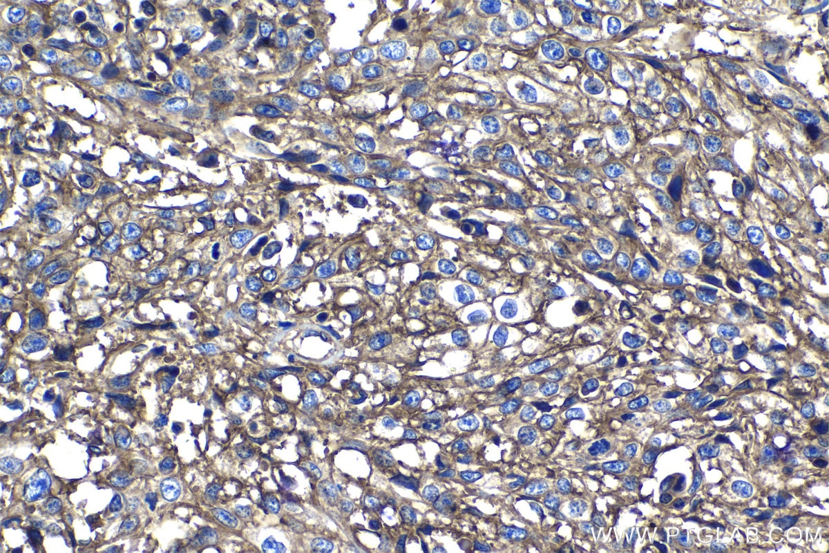 Immunohistochemistry (IHC) staining of human cervical cancer tissue using CD46 Polyclonal antibody (12494-1-AP)