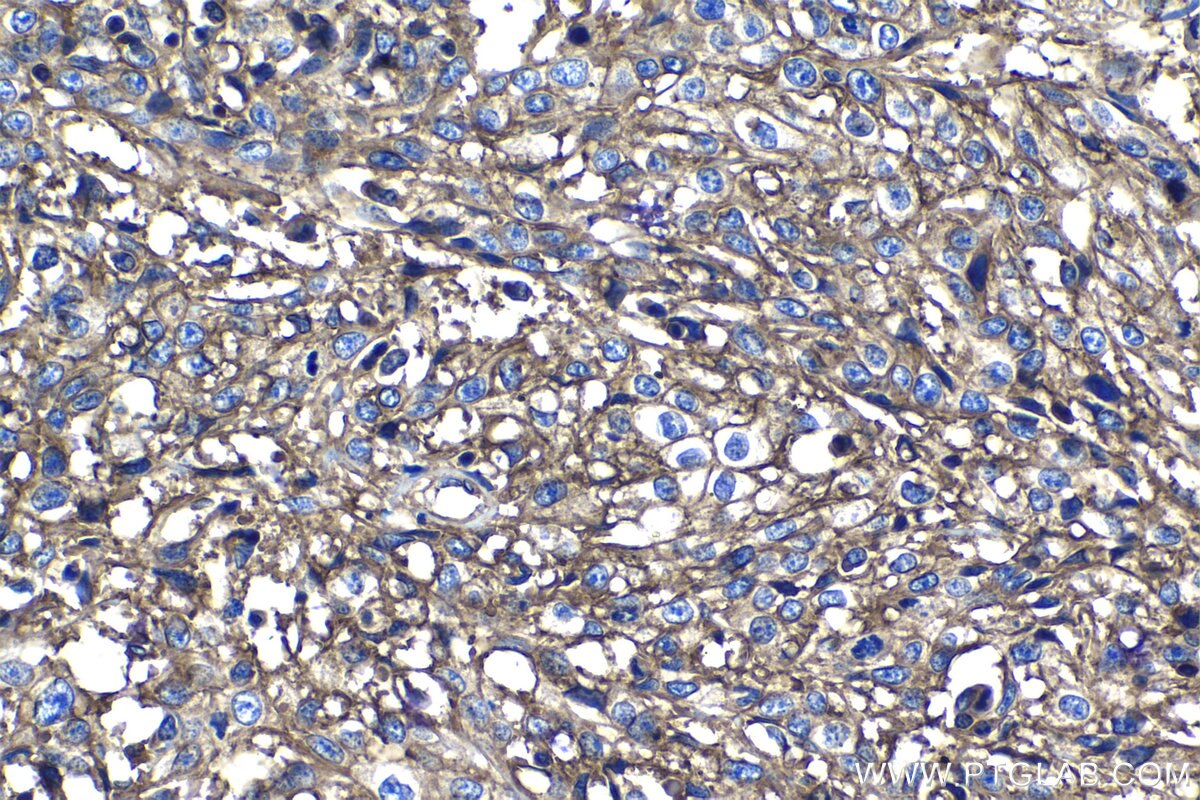 Immunohistochemistry (IHC) staining of human cervical cancer tissue using CD46 Polyclonal antibody (12494-1-AP)