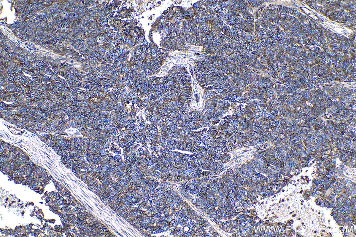 Immunohistochemistry (IHC) staining of human ovary tumor tissue using CD46 Polyclonal antibody (12494-1-AP)