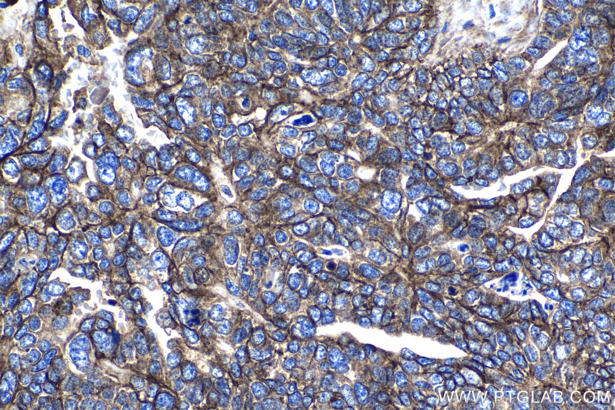 Immunohistochemistry (IHC) staining of human ovary tumor tissue using CD46 Polyclonal antibody (12494-1-AP)