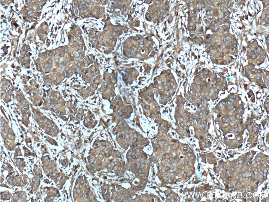 Immunohistochemistry (IHC) staining of human breast cancer tissue using CD46 Polyclonal antibody (12494-1-AP)