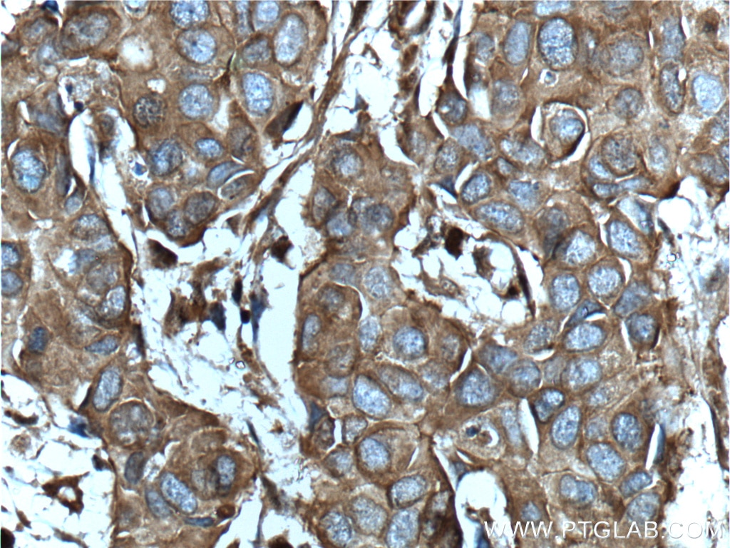 Immunohistochemistry (IHC) staining of human breast cancer tissue using CD46 Polyclonal antibody (12494-1-AP)