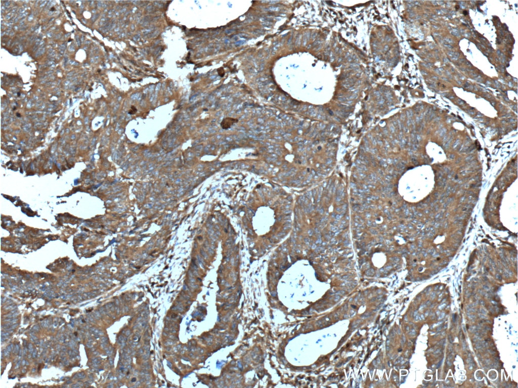 Immunohistochemistry (IHC) staining of human colon cancer tissue using CD46 Polyclonal antibody (12494-1-AP)