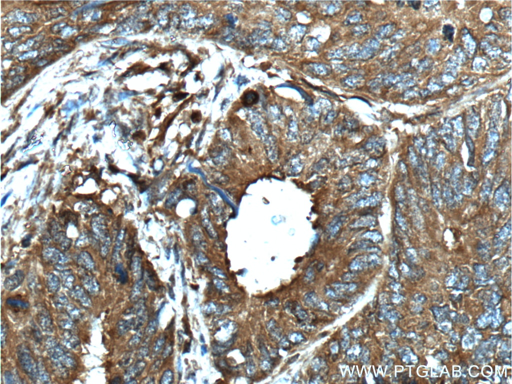 Immunohistochemistry (IHC) staining of human colon cancer tissue using CD46 Polyclonal antibody (12494-1-AP)