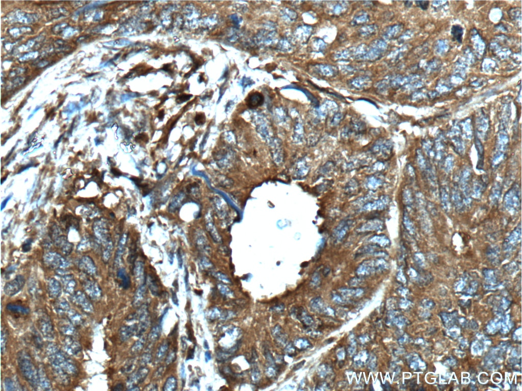 Immunohistochemistry (IHC) staining of human colon cancer tissue using CD46 Polyclonal antibody (12494-1-AP)