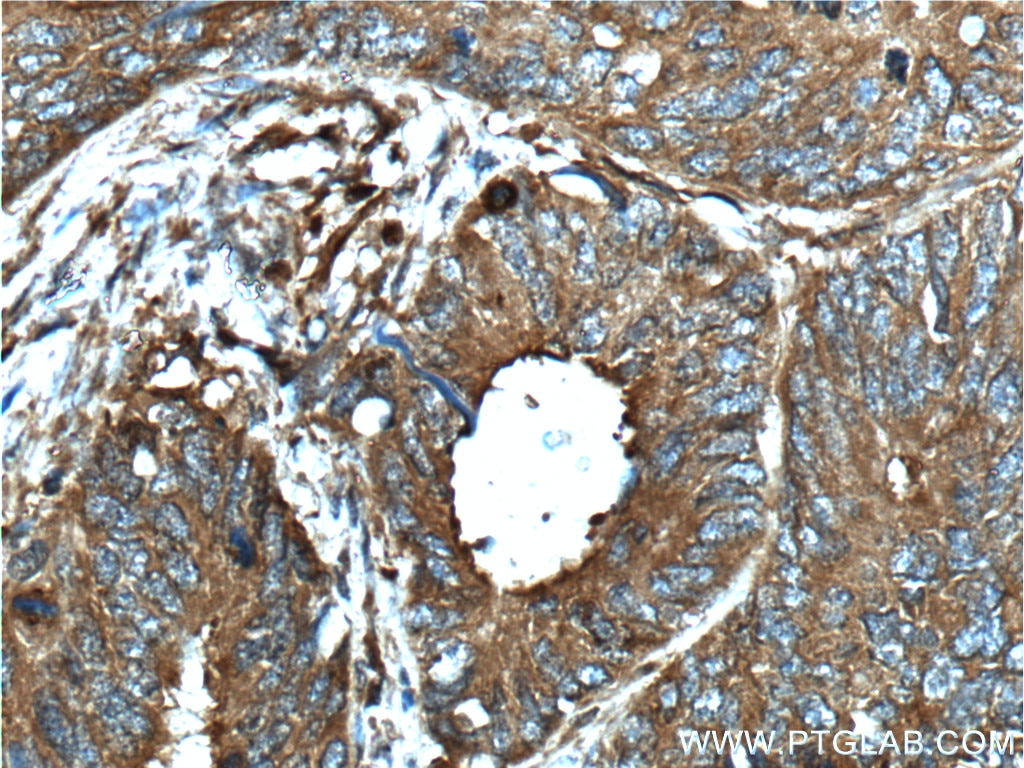 IHC staining of human colon cancer using 12494-1-AP