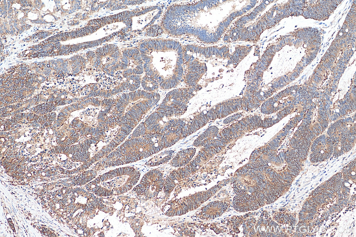 Immunohistochemistry (IHC) staining of human colon cancer tissue using CD46 Polyclonal antibody (28936-1-AP)