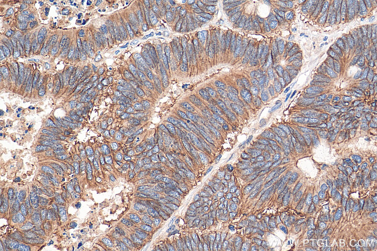 Immunohistochemistry (IHC) staining of human colon cancer tissue using CD46 Polyclonal antibody (28936-1-AP)