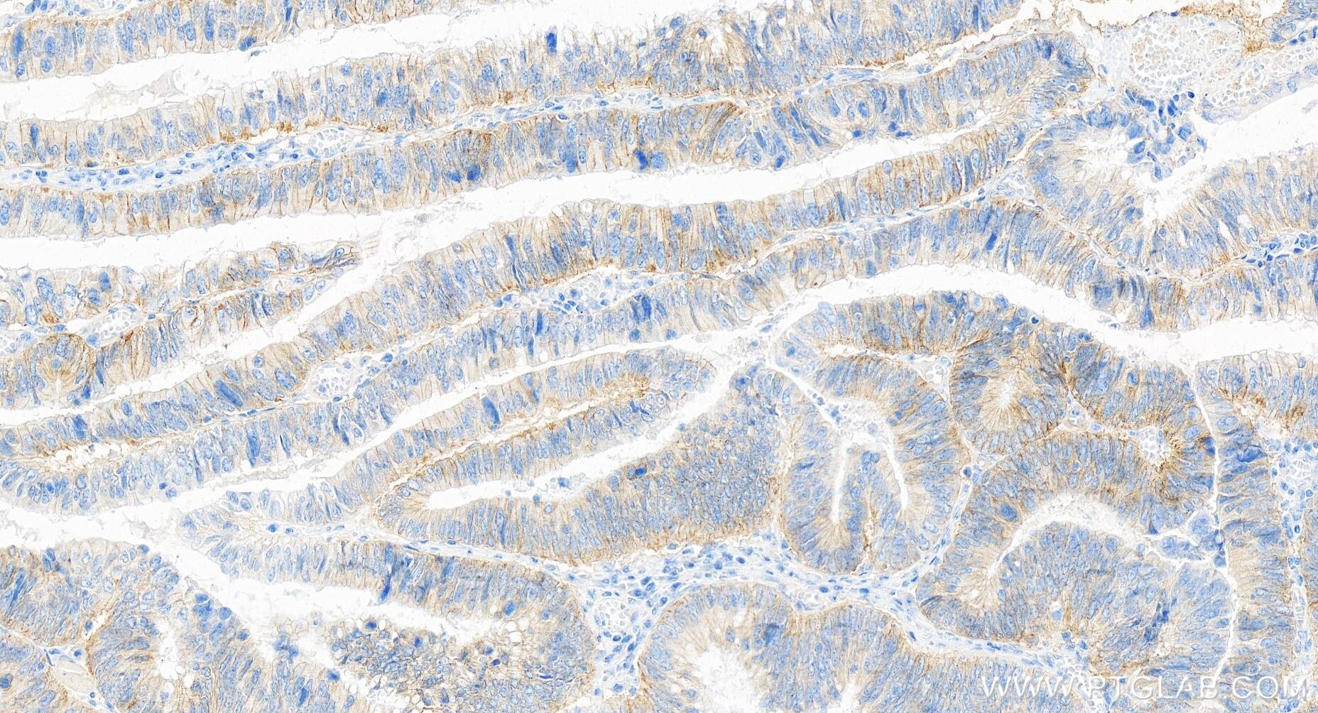 Immunohistochemistry (IHC) staining of human colon cancer tissue using CD46 Recombinant antibody (84599-5-RR)
