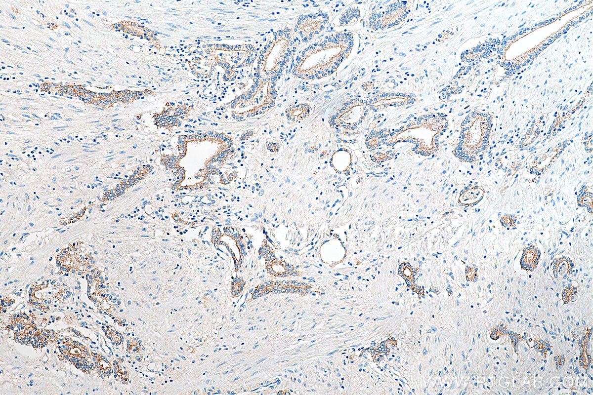 Immunohistochemistry (IHC) staining of human prostate cancer tissue using CD47 Polyclonal antibody (20305-1-AP)
