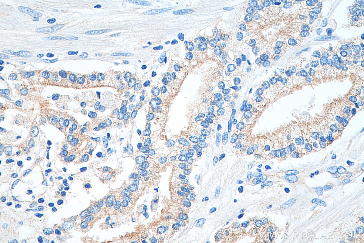 Immunohistochemistry (IHC) staining of human prostate cancer tissue using CD47 Polyclonal antibody (20305-1-AP)