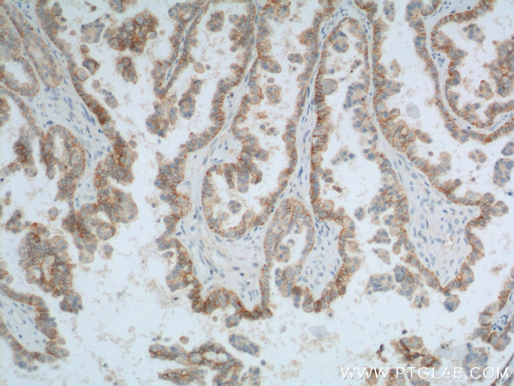 Immunohistochemistry (IHC) staining of human ovary tumor tissue using CD47 Polyclonal antibody (20305-1-AP)