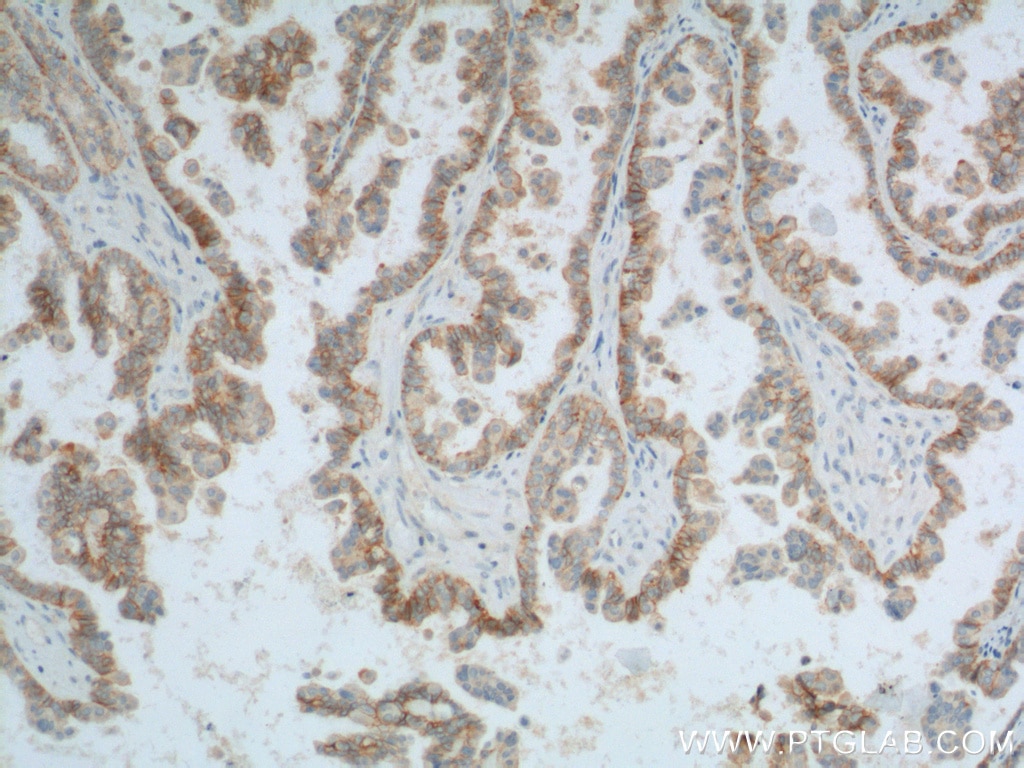 Immunohistochemistry (IHC) staining of human ovary tumor tissue using CD47 Polyclonal antibody (20305-1-AP)