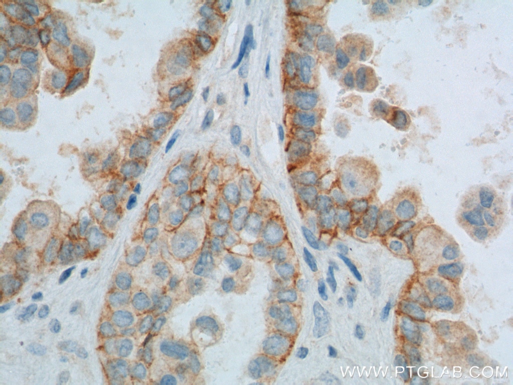 Immunohistochemistry (IHC) staining of human ovary tumor tissue using CD47 Polyclonal antibody (20305-1-AP)