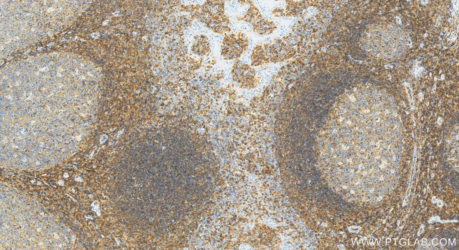 Immunohistochemistry (IHC) staining of human tonsillitis tissue using CD48 Polyclonal antibody (27519-1-AP)
