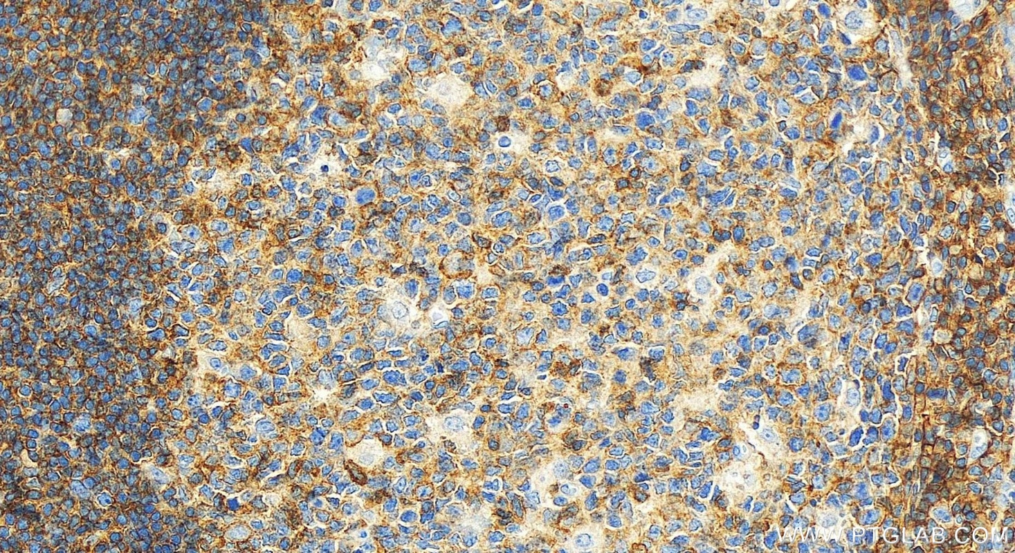 Immunohistochemistry (IHC) staining of human tonsillitis tissue using CD48 Polyclonal antibody (27519-1-AP)