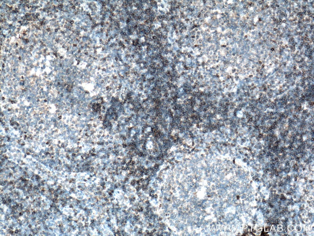 Immunohistochemistry (IHC) staining of human tonsillitis tissue using CD5 Polyclonal antibody (17227-1-AP)