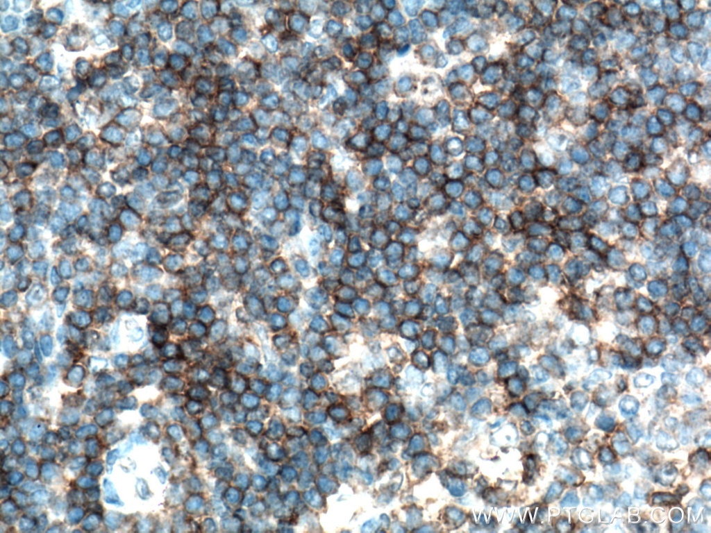 Immunohistochemistry (IHC) staining of human tonsillitis tissue using CD5 Polyclonal antibody (17227-1-AP)