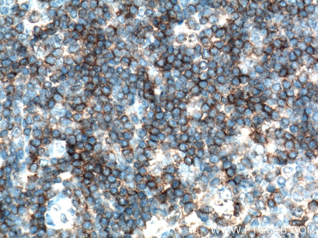 IHC staining of human tonsillitis using 17227-1-AP