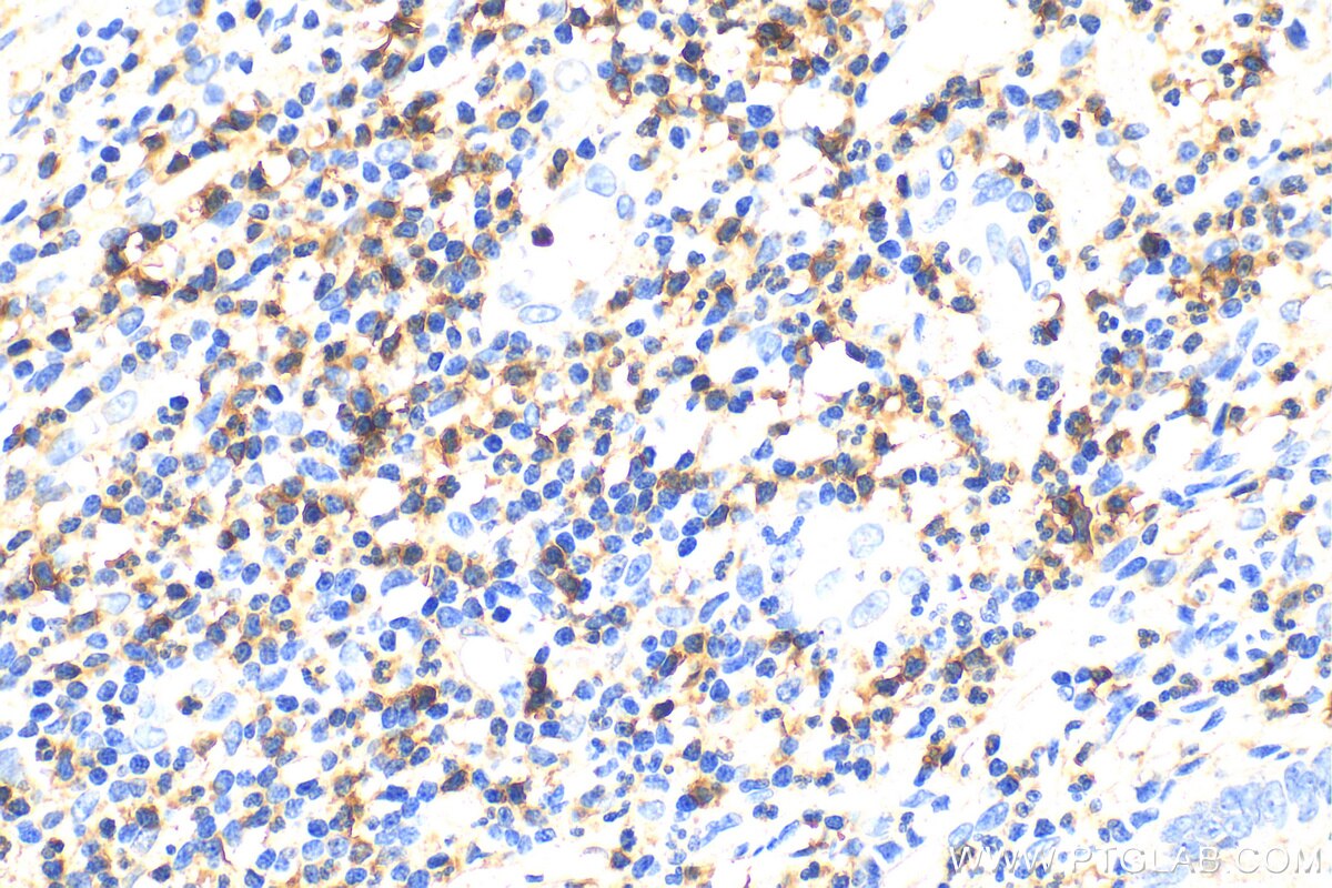 Immunohistochemistry (IHC) staining of human appendicitis tissue using CD5 Polyclonal antibody (31502-1-AP)