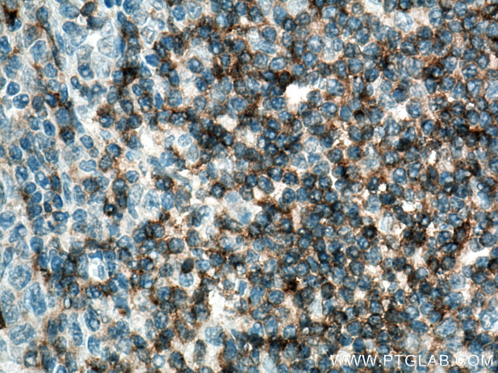 Immunohistochemistry (IHC) staining of human tonsillitis tissue using CD5 Monoclonal antibody (67278-1-Ig)