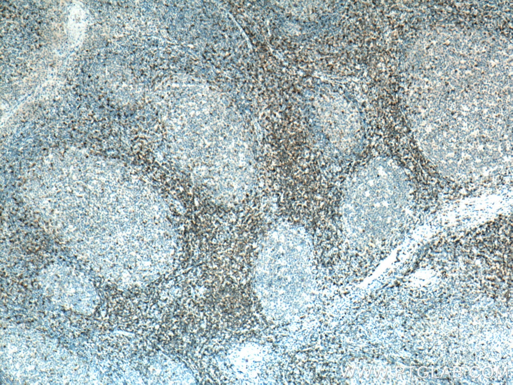 Immunohistochemistry (IHC) staining of human tonsillitis tissue using CD5 Monoclonal antibody (67278-1-Ig)