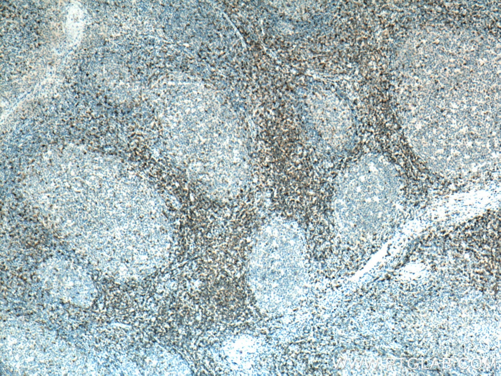 IHC staining of human tonsillitis using 67278-1-Ig