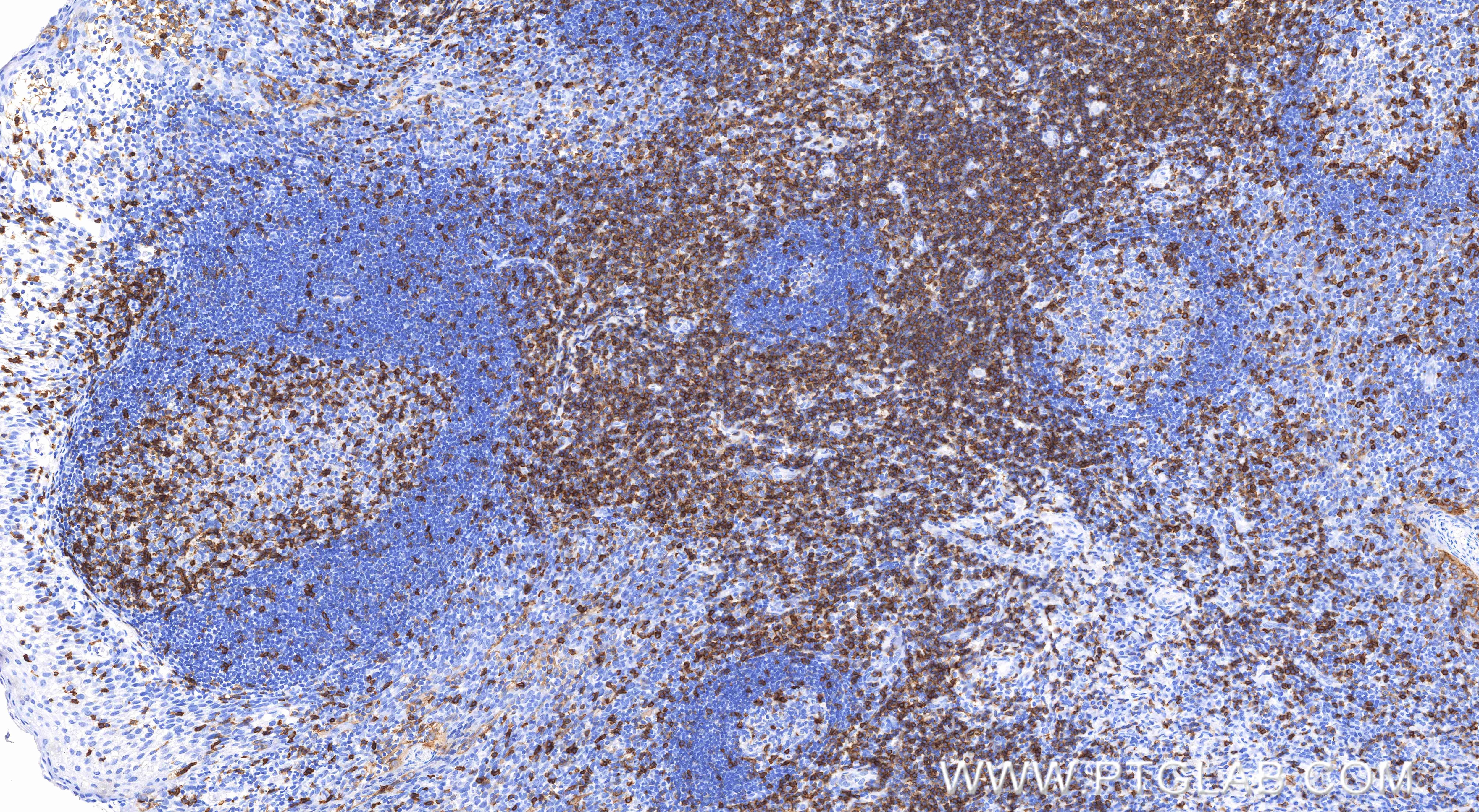 Immunohistochemical analysis of paraffin-embedded human tonsil tissue slide using 83543-7-RR (CD5 antibody) at dilution of 1:3000 (under 10x lens). Heat mediated antigen retrieval with Tris-EDTA buffer (pH 9.0). Immunohistochemistry (IHC) staining of human tonsil tissue using CD5 Recombinant monoclonal antibody (83543-7-RR)