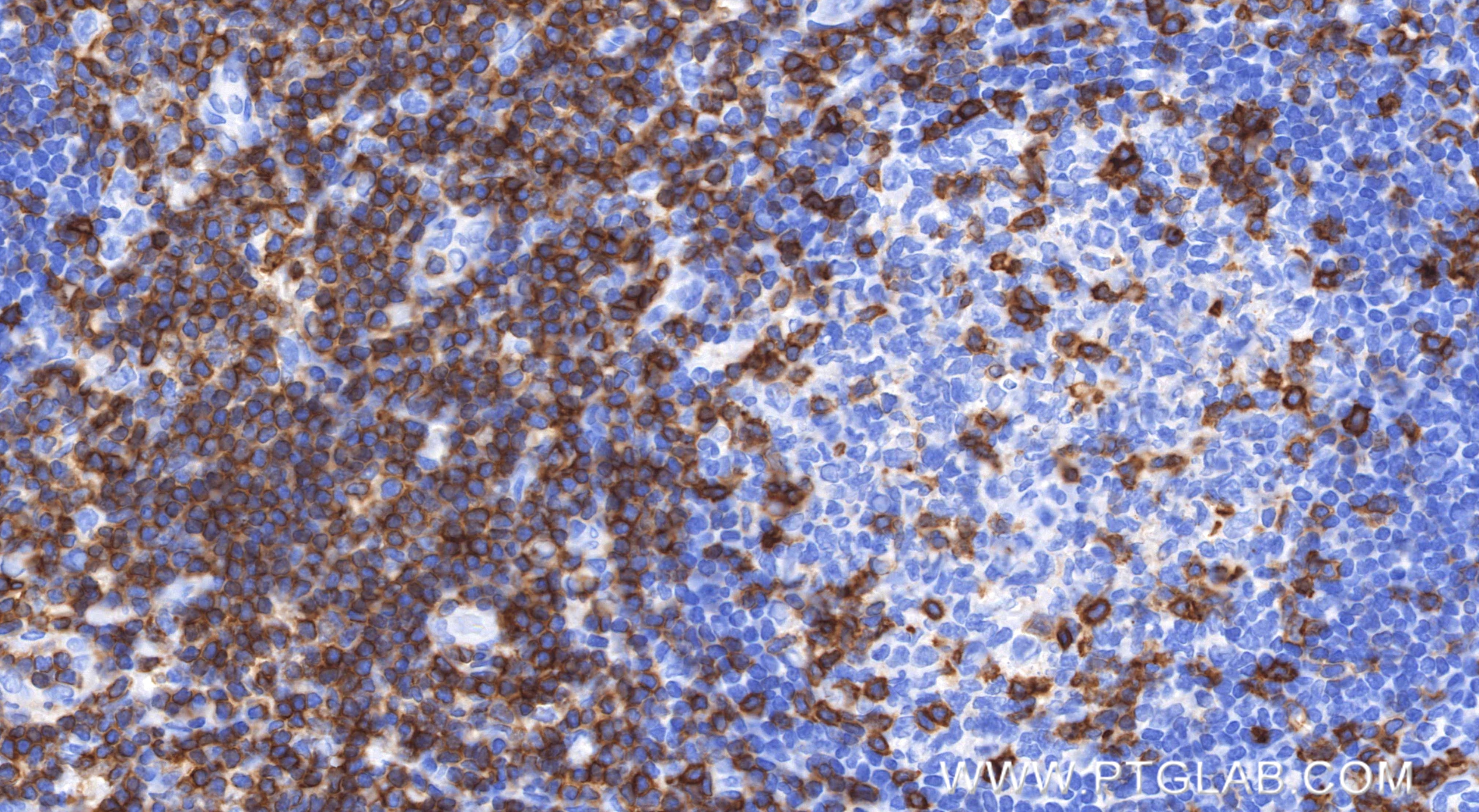 Immunohistochemical analysis of paraffin-embedded human tonsil tissue slide using 83543-7-RR (CD5 antibody) at dilution of 1:3000 (under 40x lens). Heat mediated antigen retrieval with Tris-EDTA buffer (pH 9.0). Immunohistochemistry (IHC) staining of human tonsil tissue using CD5 Recombinant monoclonal antibody (83543-7-RR)