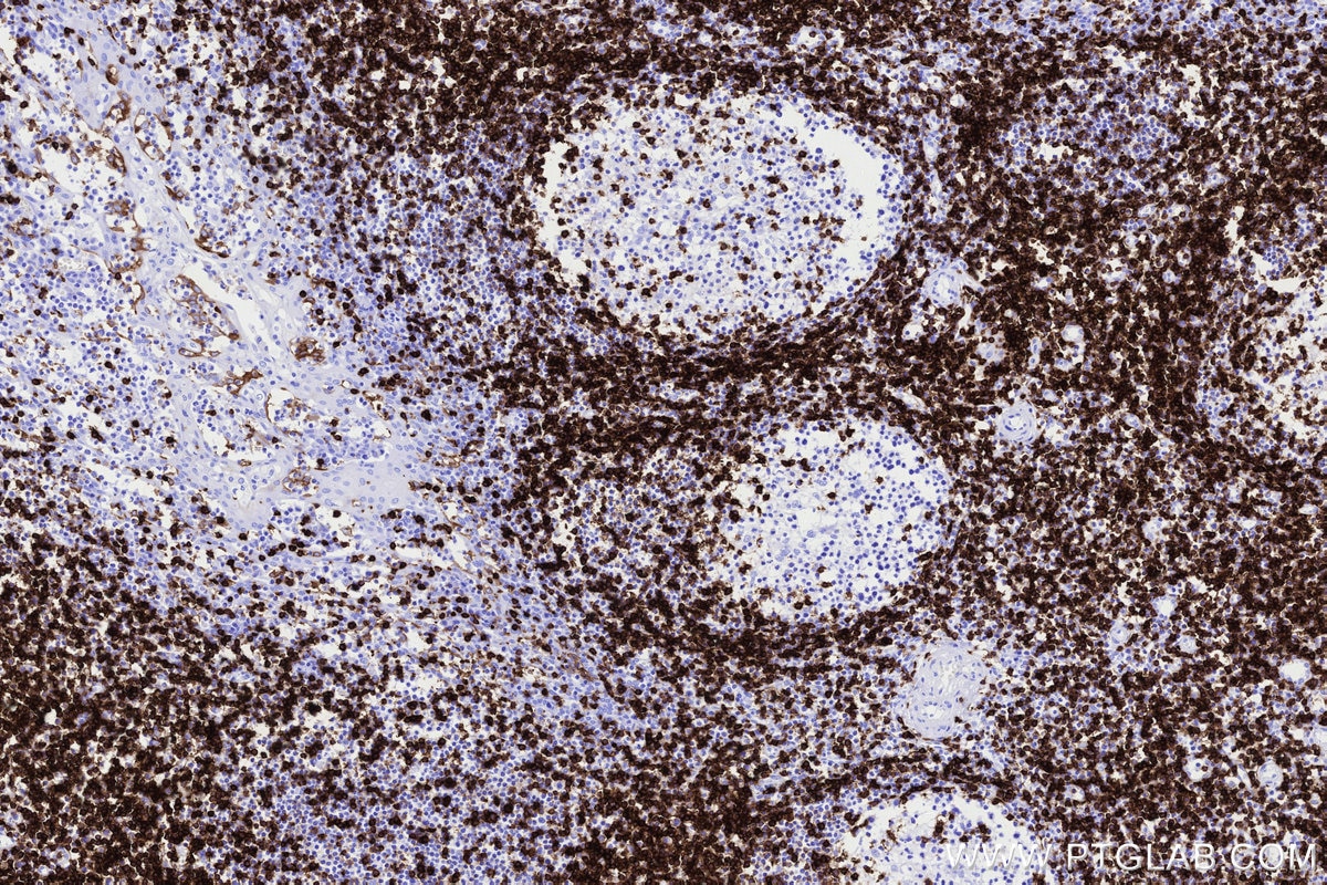 IHC staining of human tonsillitis using 83543-7-RR Immunohistochemistry (IHC) staining of human tonsillitis tissue using CD5 Recombinant monoclonal antibody (83543-7-RR)