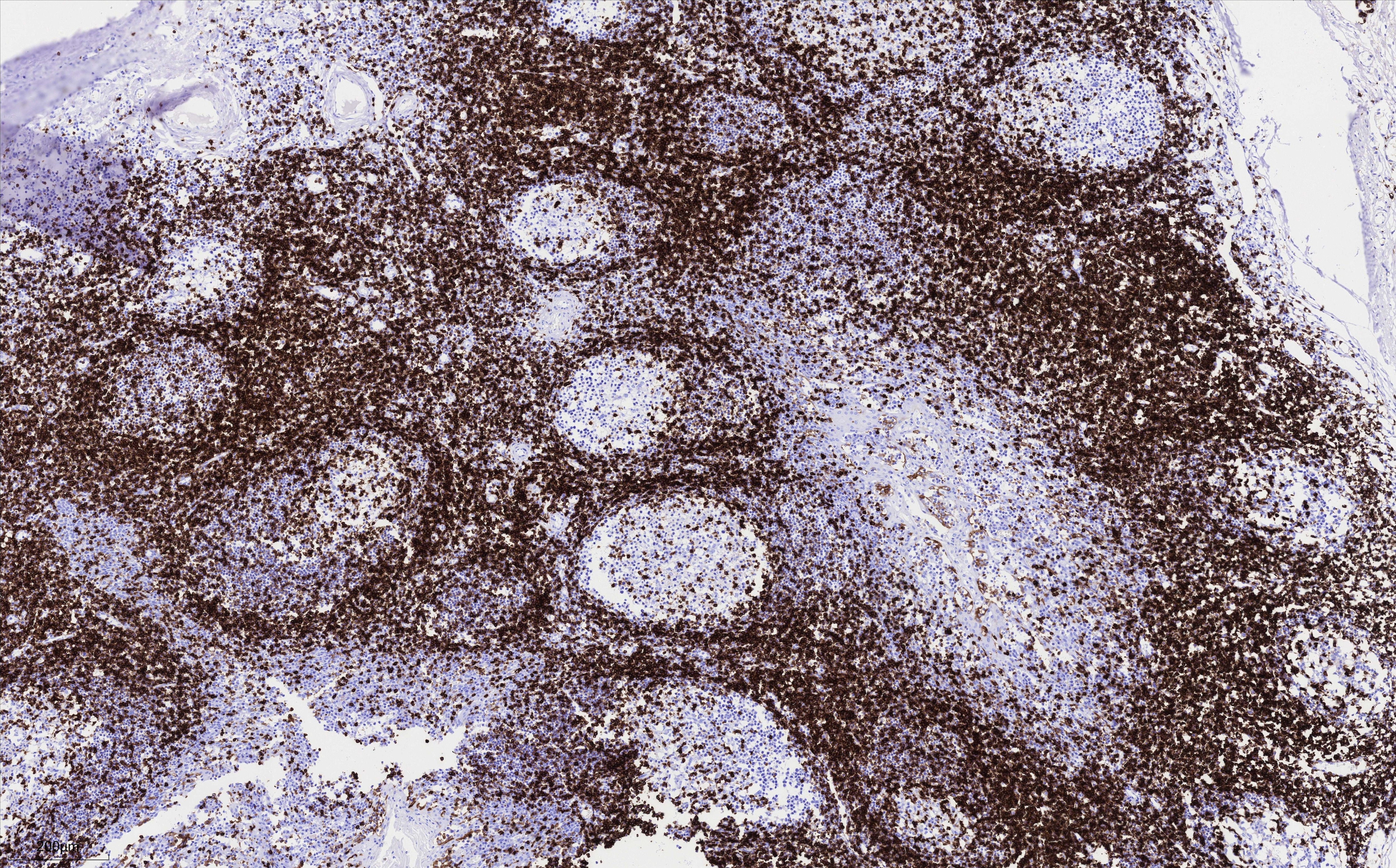 IHC staining of human tonsillitis using 83543-7-RR Immunohistochemistry (IHC) staining of human tonsillitis tissue using CD5 Recombinant monoclonal antibody (83543-7-RR)