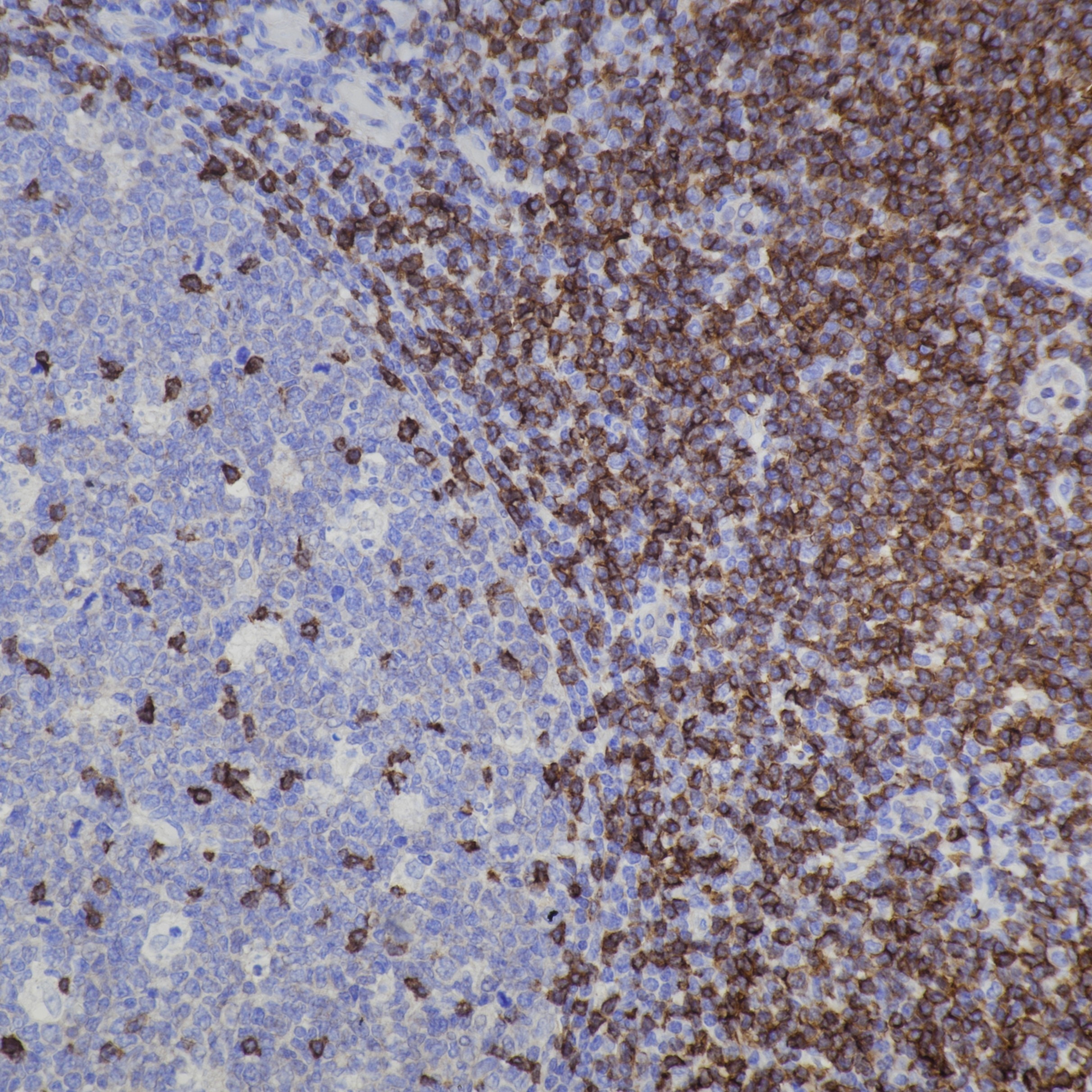 IHC staining of human tonsil using 83543-7-RR Immunohistochemistry (IHC) staining of human tonsil tissue using CD5 Recombinant monoclonal antibody (83543-7-RR)