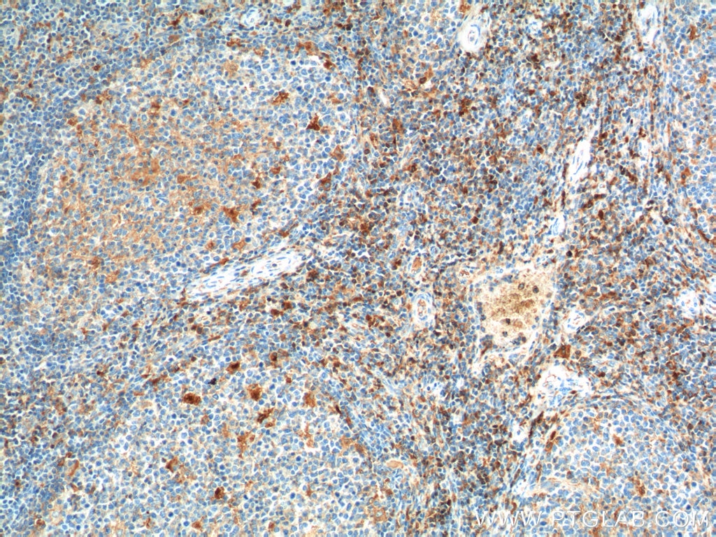 Immunohistochemistry (IHC) staining of human tonsillitis tissue using CD52 Polyclonal antibody (21809-1-AP)