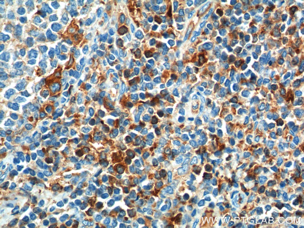 Immunohistochemistry (IHC) staining of human tonsillitis tissue using CD52 Polyclonal antibody (21809-1-AP)