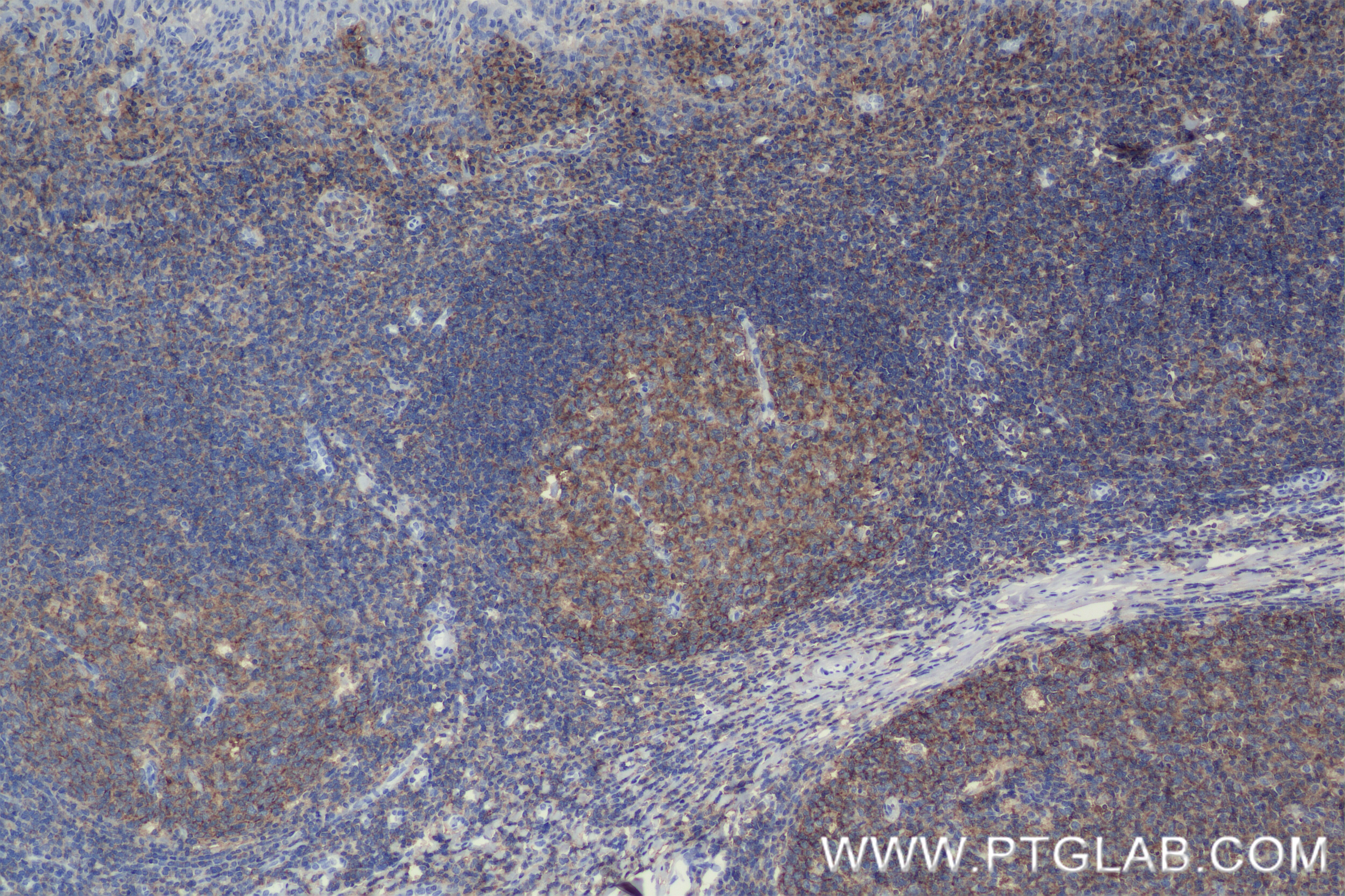 Immunohistochemistry (IHC) staining of human tonsillitis tissue using CD53 Recombinant antibody (84837-1-RR)