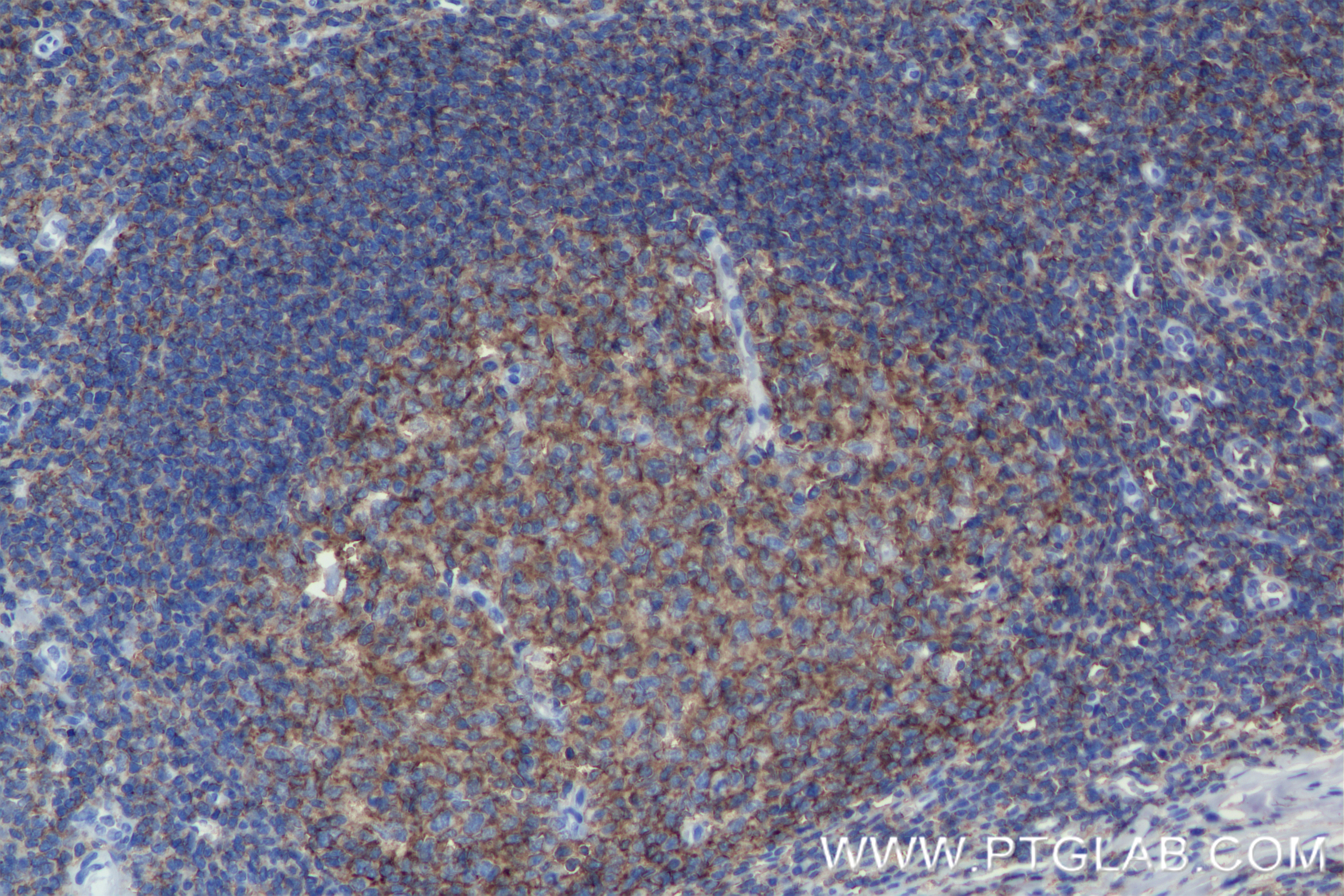 Immunohistochemistry (IHC) staining of human tonsillitis tissue using CD53 Recombinant antibody (84837-1-RR)