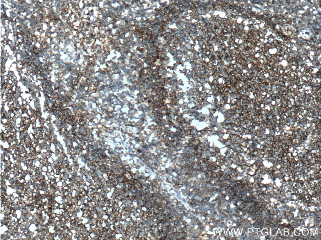 IHC staining of human tonsillitis using 26580-1-AP