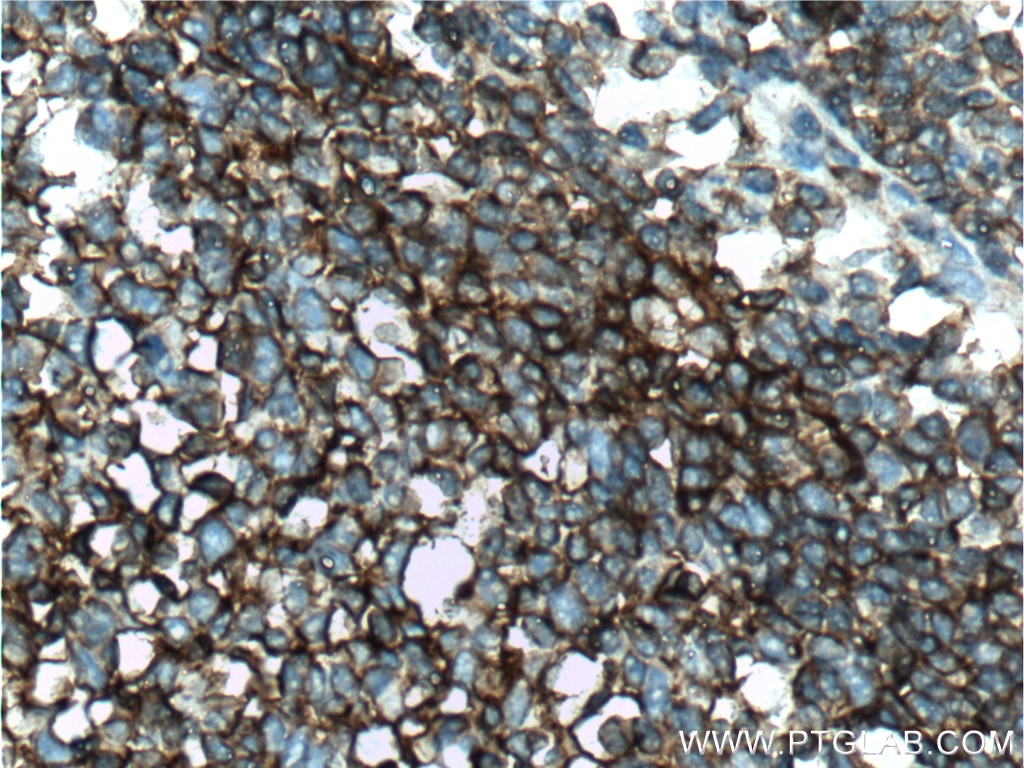 Immunohistochemistry (IHC) staining of human tonsillitis tissue using CD55 Polyclonal antibody (26580-1-AP)