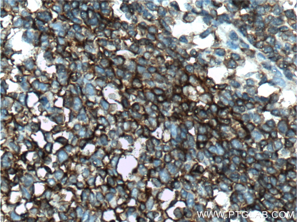 IHC staining of human tonsillitis using 26580-1-AP