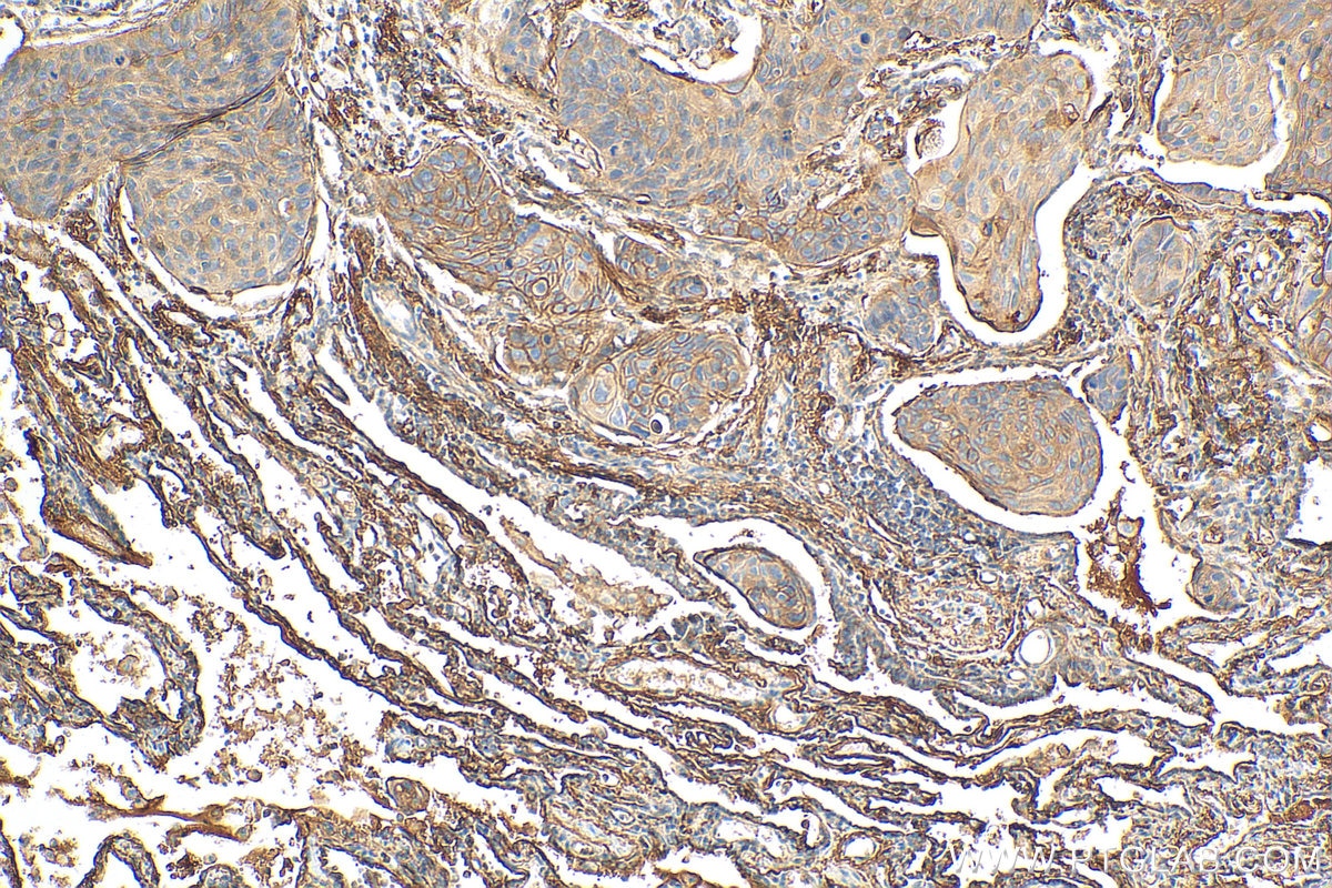 Immunohistochemistry (IHC) staining of human lung cancer tissue using CD55 Recombinant antibody (82781-6-RR)