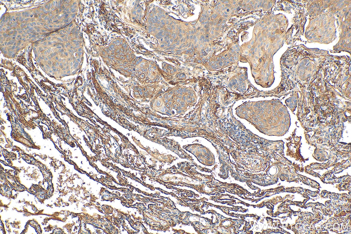 IHC staining of human lung cancer using 82781-6-RR