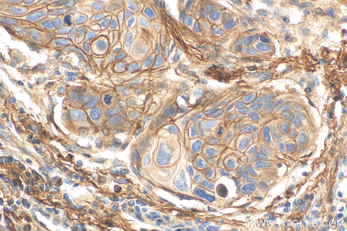 Immunohistochemistry (IHC) staining of human lung cancer tissue using CD55 Recombinant antibody (82781-6-RR)