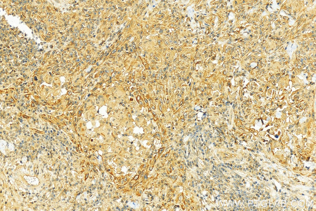 Immunohistochemistry (IHC) staining of human skin cancer tissue using CD58 Polyclonal antibody (10878-1-AP)