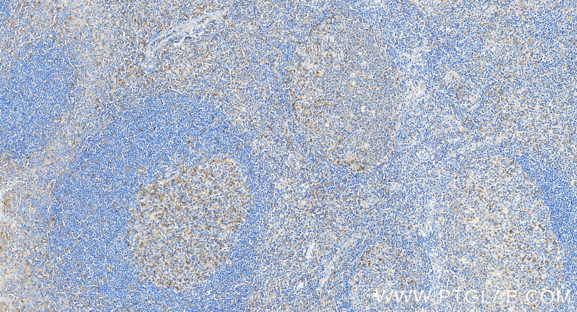 Immunohistochemistry (IHC) staining of human tonsillitis tissue using CD58 Recombinant monoclonal antibody (85950-1-RR)